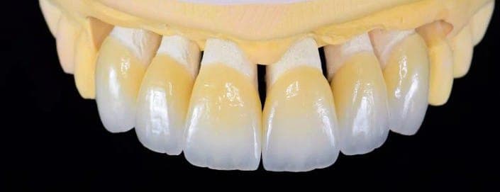 Facetas feldspáticas em modelo odontológico sobre bancada de laboratório