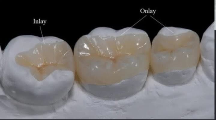 Restaurações inlay e onlay em cerâmica feldspática em bancada de laboratório