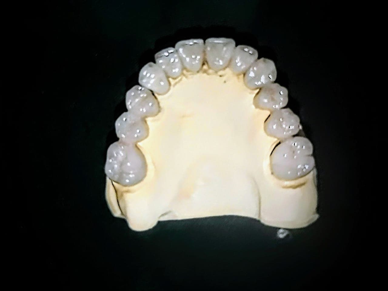Reabilitação em metalocerâmica em modelo odontológico de laboratório